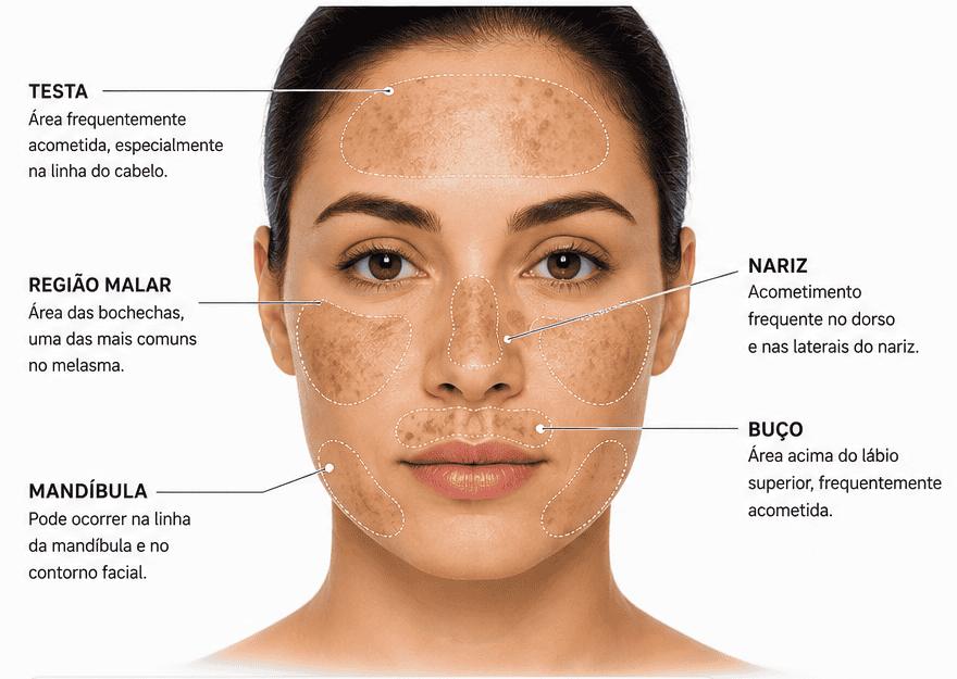 Tratamento do Melasma: Como Controlar as Manchas Segundo a Ciência