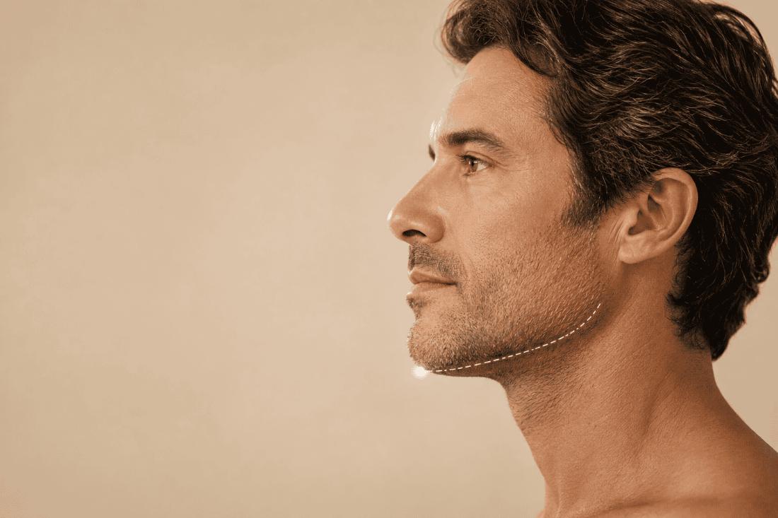 Preenchimento de mento: guia completo para equilibrar o queixo, a mandíbula e o perfil facial