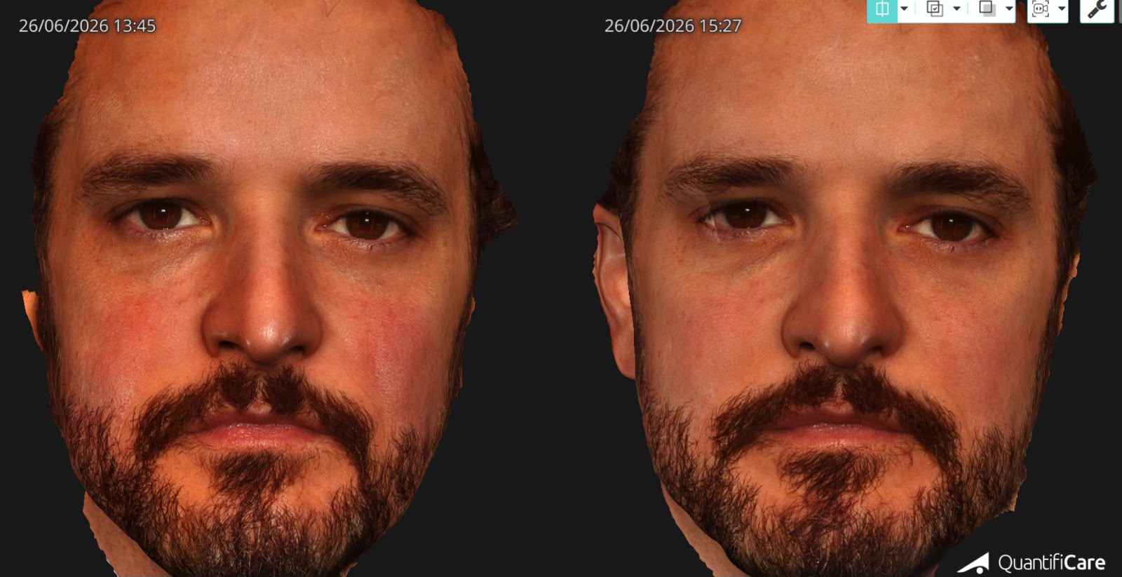 Reconstrução 3D facial pelo sistema QuantifiCare LifeViz, comparando dois registros do mesmo paciente em horários diferentes