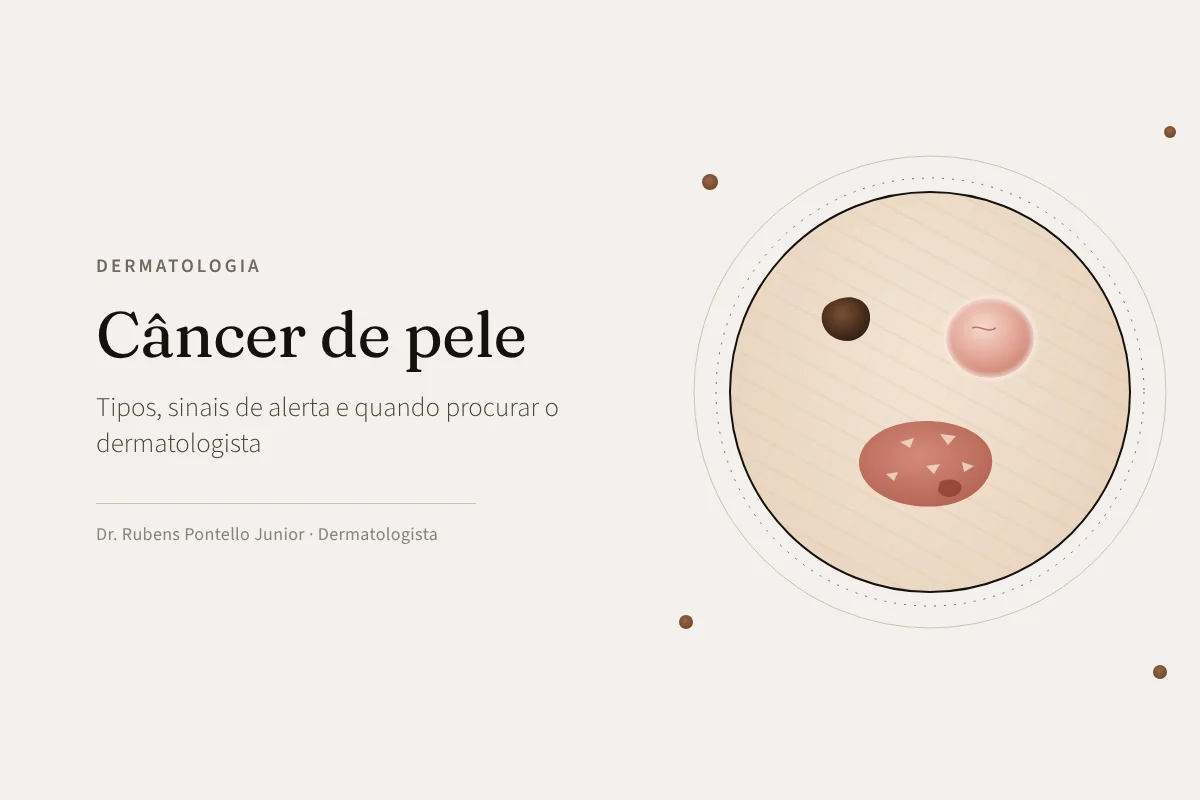 Câncer de pele: tipos, sinais de alerta e quando procurar o dermatologista