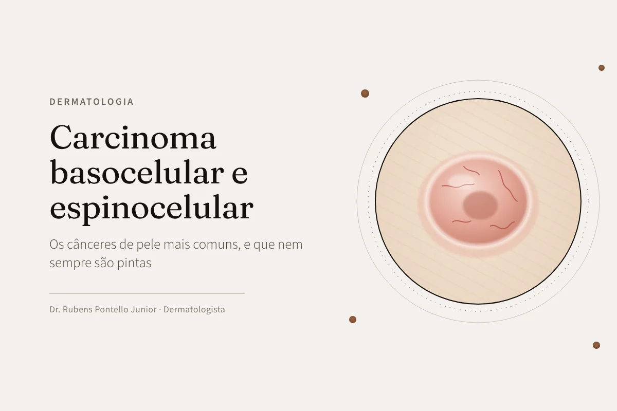 Carcinoma basocelular e espinocelular: os cânceres de pele mais comuns, e que nem sempre são pintas