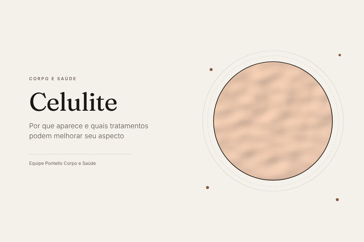 Ilustração de pele com relevo ondulado e pequenas depressões ampliada por lente, capa do artigo sobre celulite