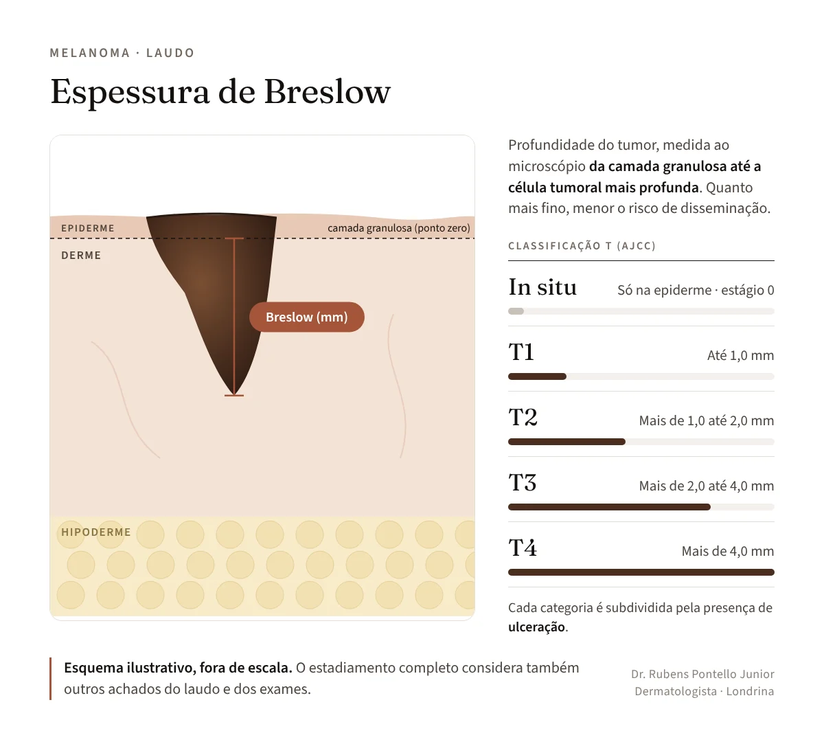 Esquema da espessura de Breslow nas camadas da pele e classificação T1 a T4 do melanoma