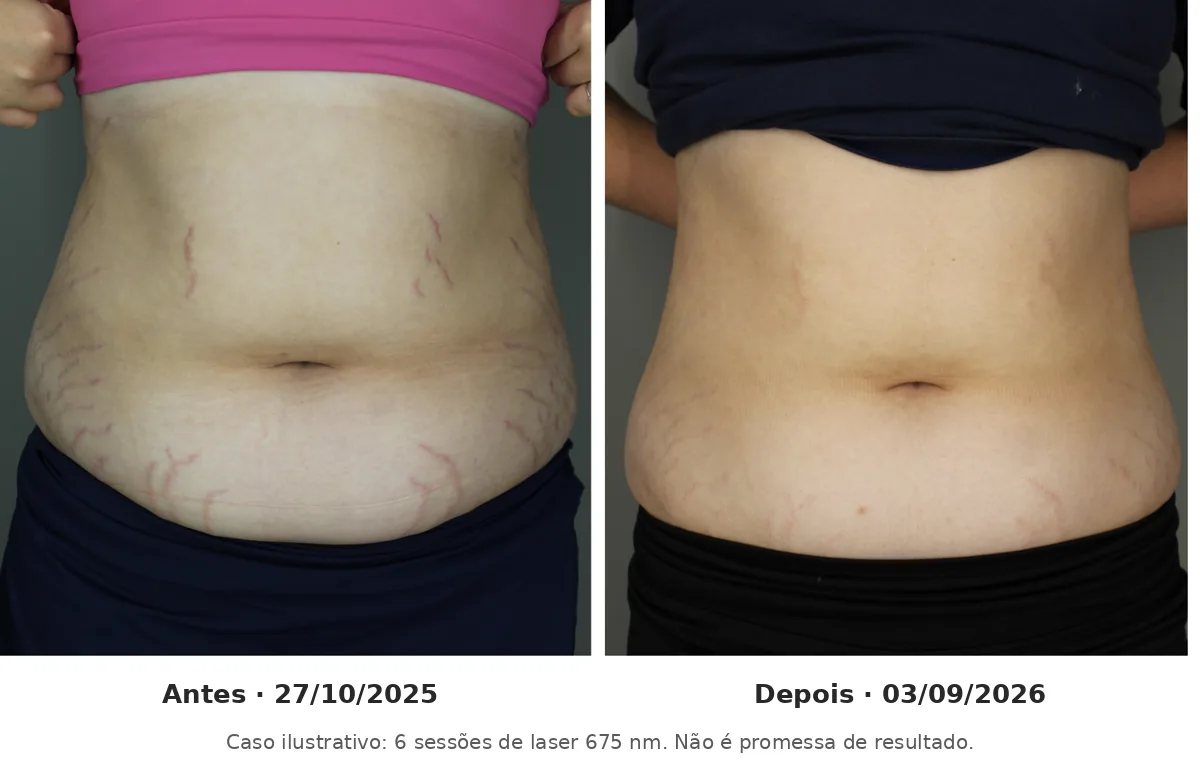 Abdome com estrias vermelhas antes e depois de 6 sessões de laser de 675 nm, caso ilustrativo