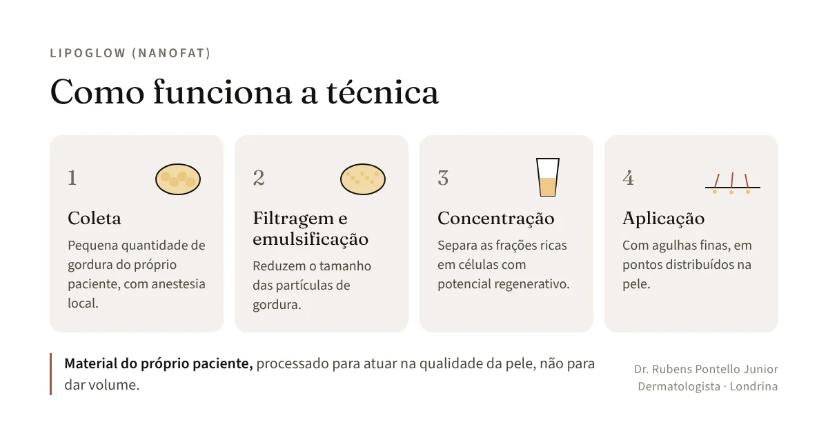 Infográfico das quatro etapas do Lipoglow: coleta de pequena quantidade de gordura do próprio paciente, filtragem e emulsificação, concentração das frações ricas em células e aplicação com agulhas finas na pele