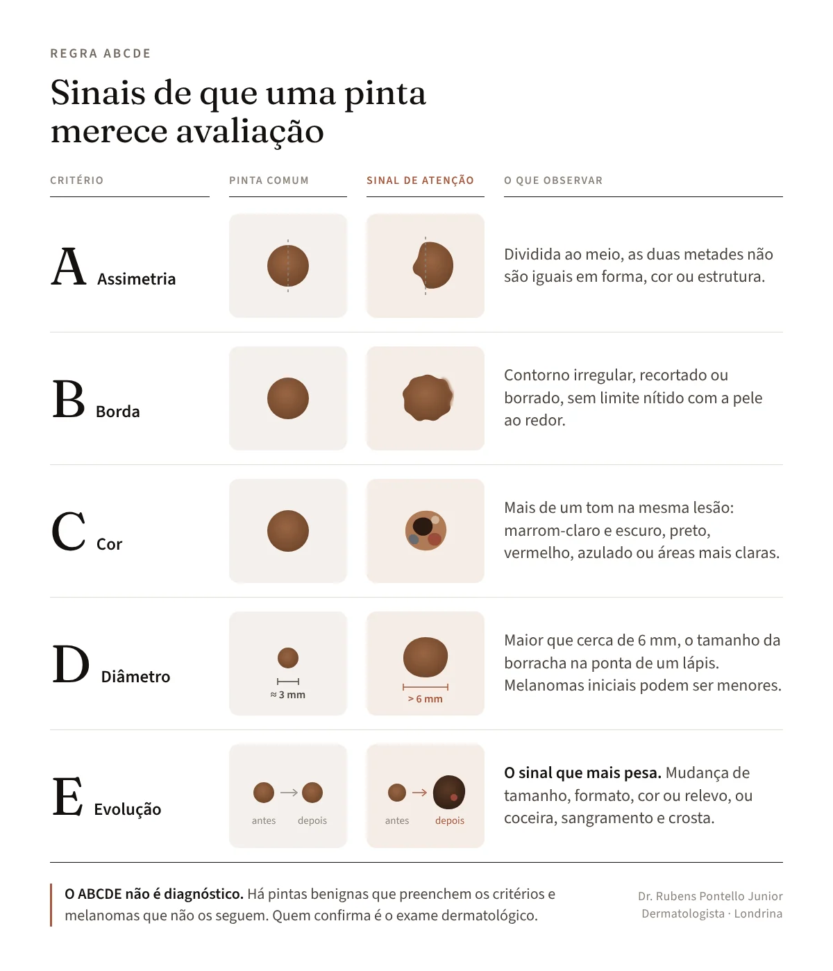 Infográfico da regra ABCDE comparando pinta comum e sinal de atenção: assimetria, borda, cor, diâmetro e evolução