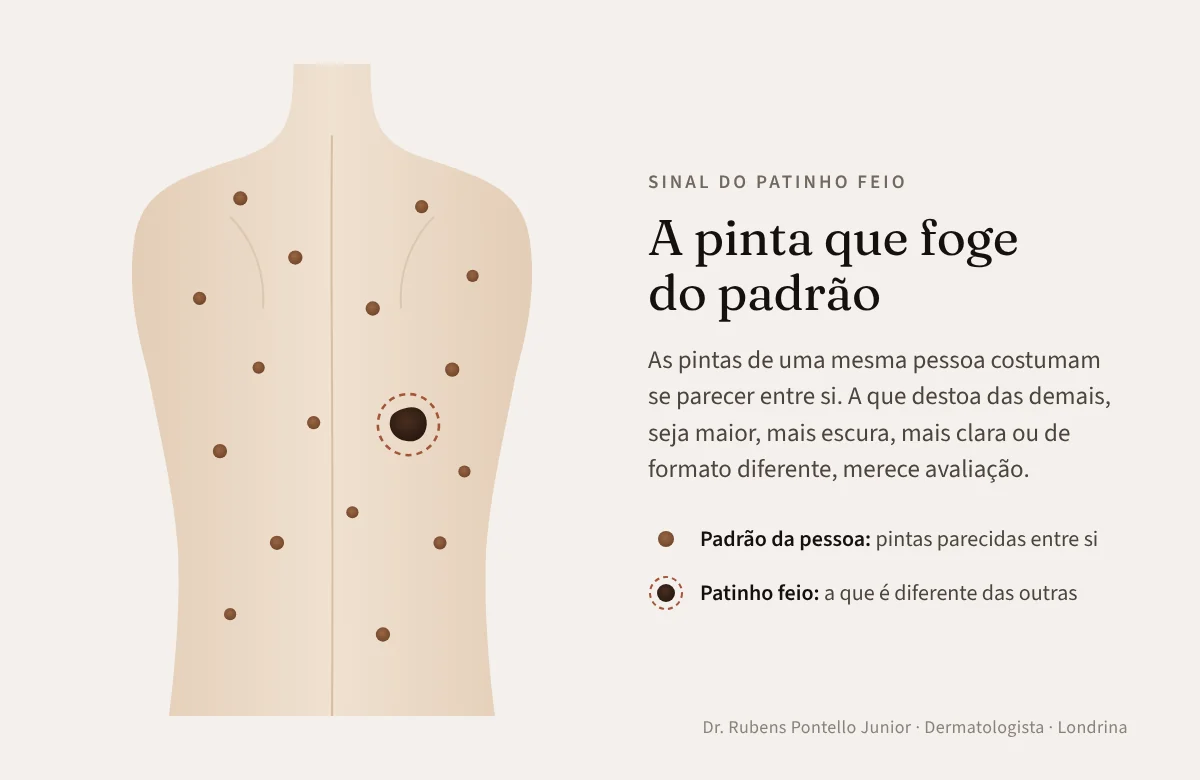 Ilustração de costas com várias pintas parecidas e uma pinta diferente destacada, representando o sinal do patinho feio
