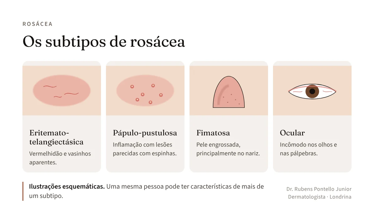 Ilustrações esquemáticas dos quatro subtipos de rosácea: eritemato-telangiectásica, pápulo-pustulosa, fimatosa e ocular