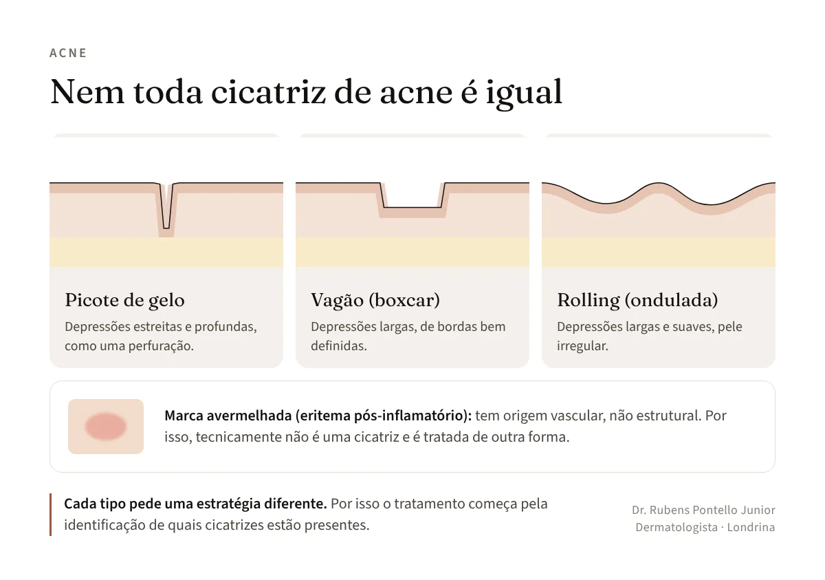 Corte esquemático da pele com os três tipos de cicatriz de acne: picote de gelo, vagão (boxcar) e rolling (ondulada), além da marca avermelhada pós-inflamatória, que não é cicatriz