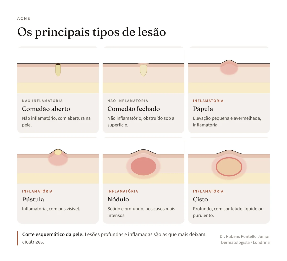 Corte esquemático da pele com os tipos de lesão da acne: comedão aberto e comedão fechado, não inflamatórios, e pápula, pústula, nódulo e cisto, inflamatórios